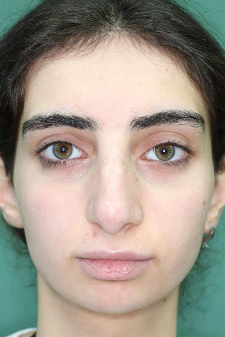 Before image 1 Case #122491 - Aesthetic Reduction Rhinoseptoplasty