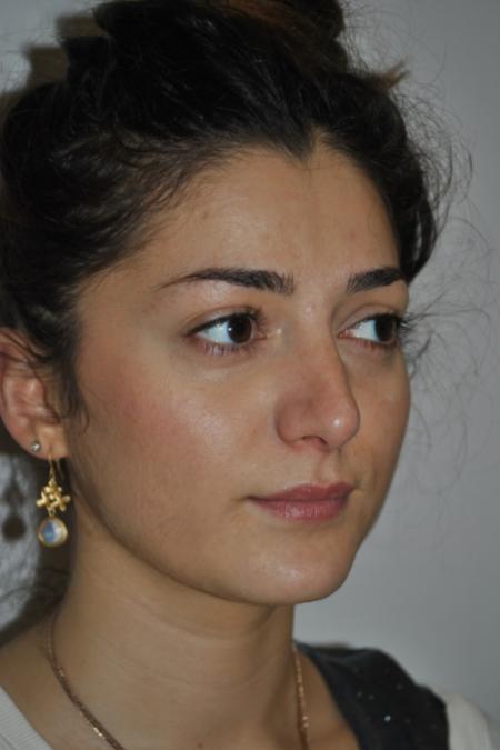 After image 2 Case #122741 - Primary Rhinoseptoplasty, Turbinate Lateralization