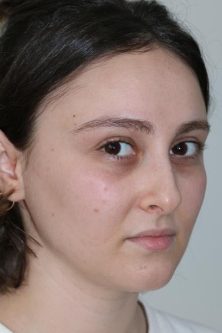 Before image 3 Case #122861 - Aesthetic Reduction Rhinoplasty