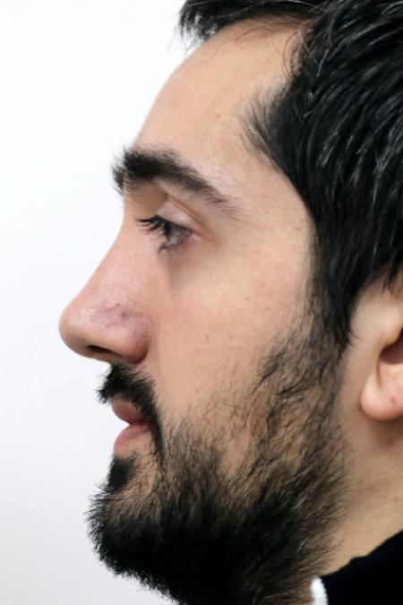 After image 4 Case #122726 - Revision Rhinoseptoplasty, Turbinoplasty