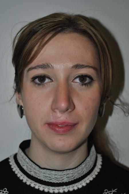 After image 1 Case #122736 - Hybrid Rhinoplasty