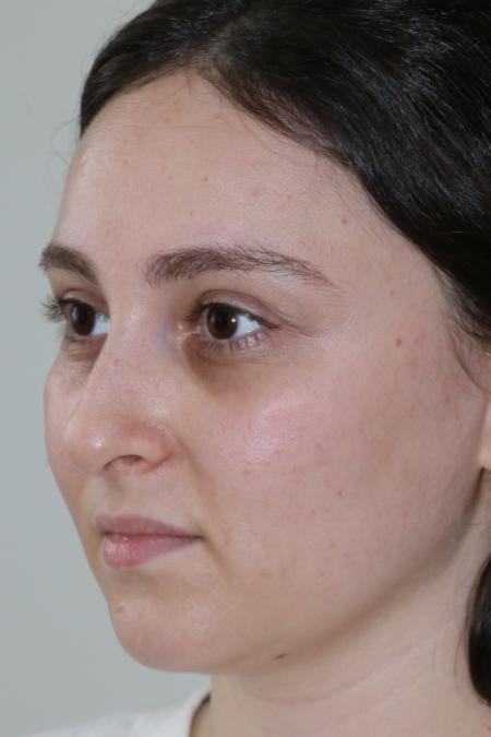 Before image 2 Case #122861 - Aesthetic Reduction Rhinoplasty