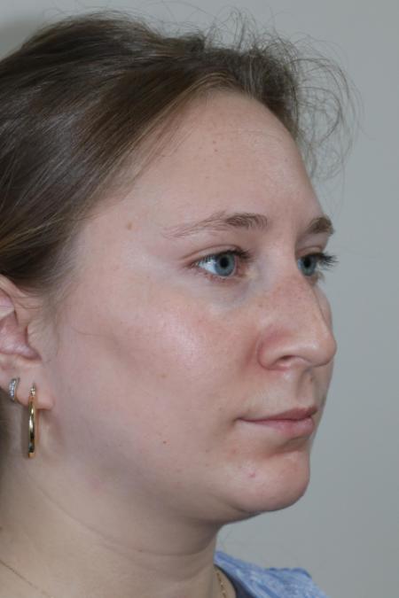 Before image 3 Case #122876 - Nasal Deviation Syndrome. Rhinogenic Headache 