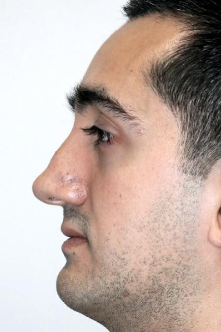 Before image 4 Case #122726 - Revision Rhinoseptoplasty, Turbinoplasty