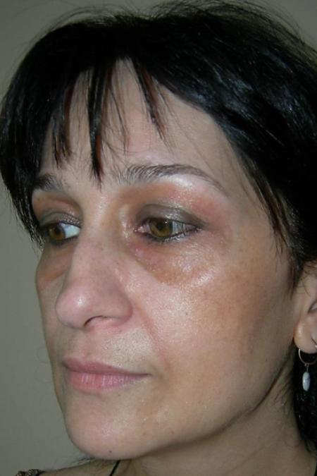 Before image 2 Case #122596 - Aging Rhinoseptoplasty