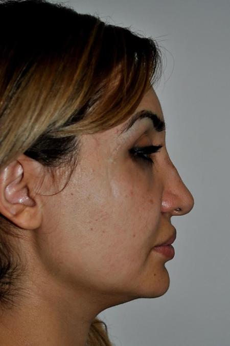 Before image 4 Case #122601 - Aging Rhinoplasty