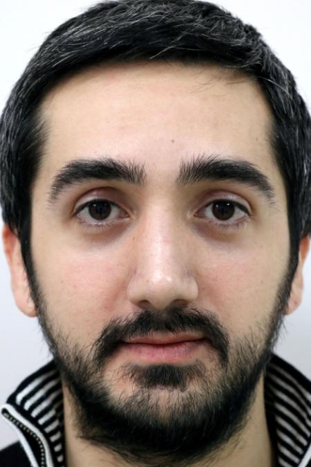 After image 1 Case #122726 - Revision Rhinoseptoplasty, Turbinoplasty