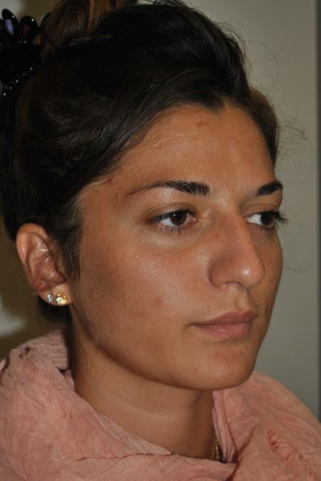 Before image 2 Case #122741 - Primary Rhinoseptoplasty, Turbinate Lateralization