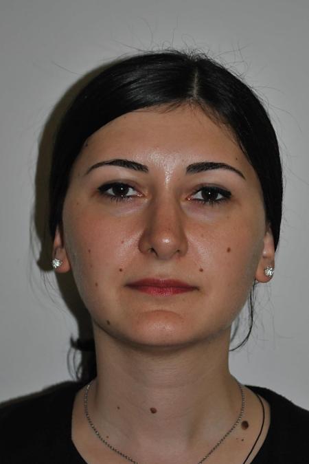 After image 1 Case #122746 - Rhinoseptoplasty
