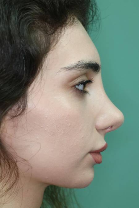 After image 5 Case #122491 - Aesthetic Reduction Rhinoseptoplasty