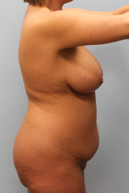 Before image 3 Case #123261 - Mommy Makeover