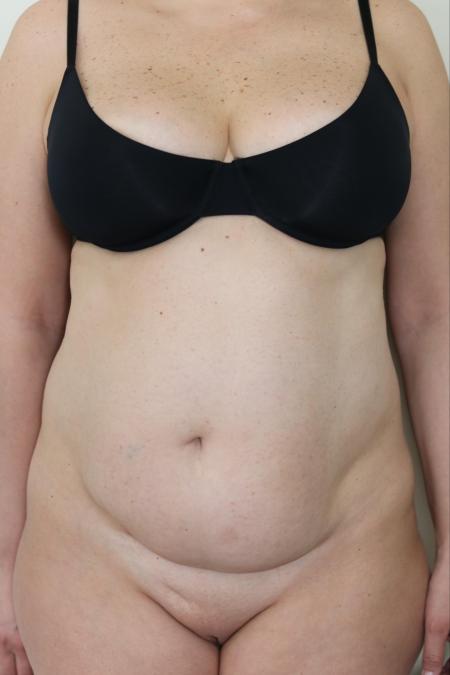 Before image 1 Case #122761 - Traditional Abdominoplasty
