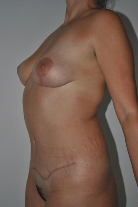 After image 3 Case #122776 - Breast Autoaugmentation And Abdominoplasty