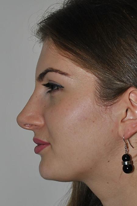 After image 5 Case #122771 - Aesthetic Reduction Rhinoplasty