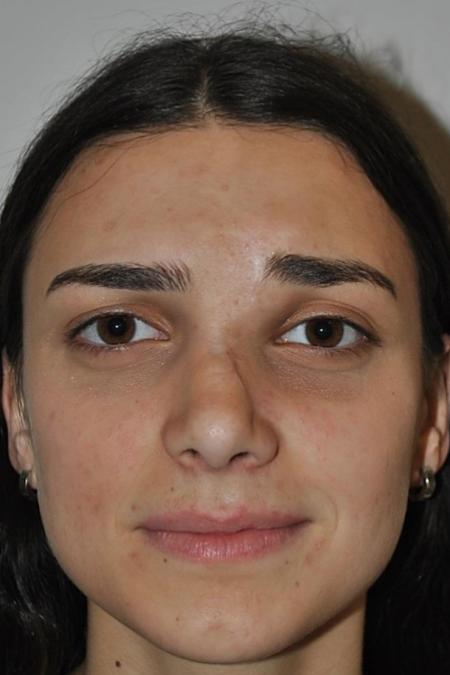 After image 1 Case #122646 - Aestetic Reduction Rhinoplasty