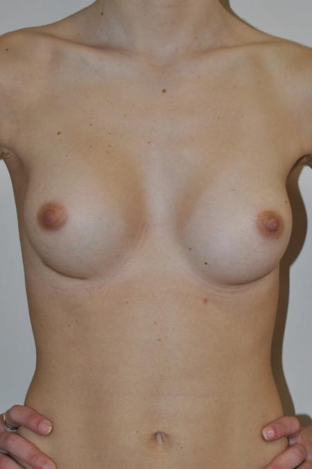 After image 1 Case #122766 - Breast Augmentation