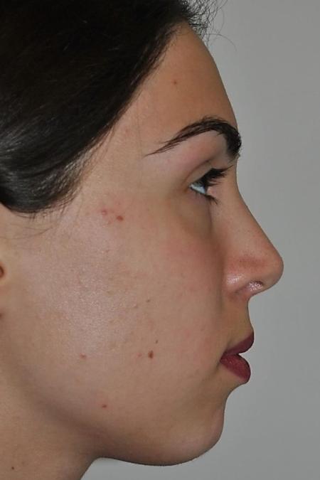 After image 4 Case #122621 - Aesthetic Reduction Rhinoseptoplasty