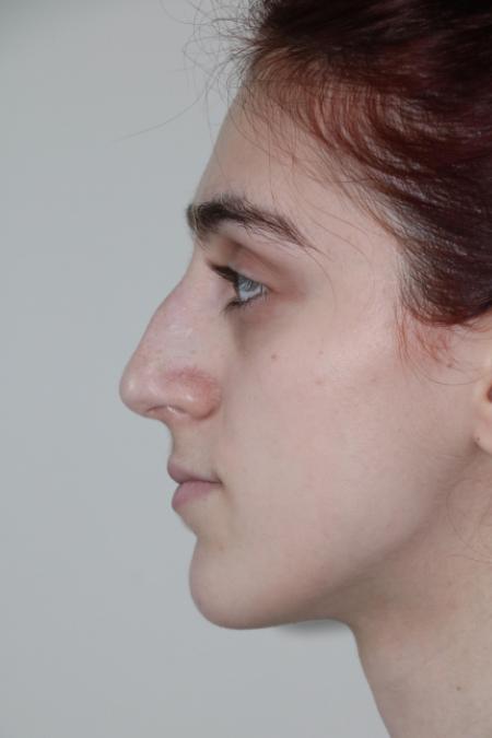Before image 5 Case #122786 - Aesthetic Reduction Rhinoseptoplasty