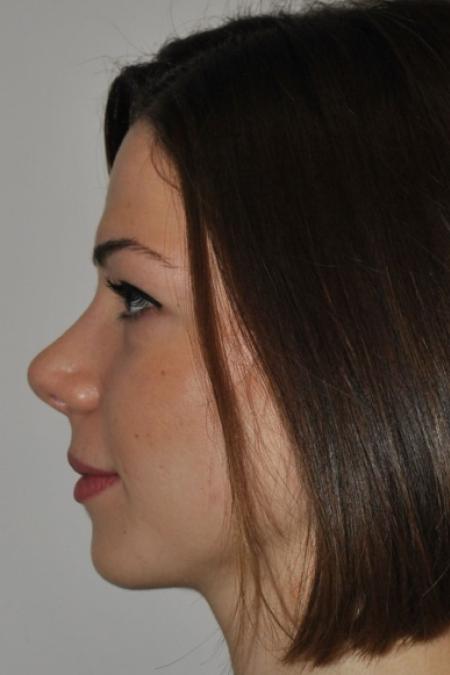 After image 5 Case #122616 - Aesthetic Reduction Rhinoplasty