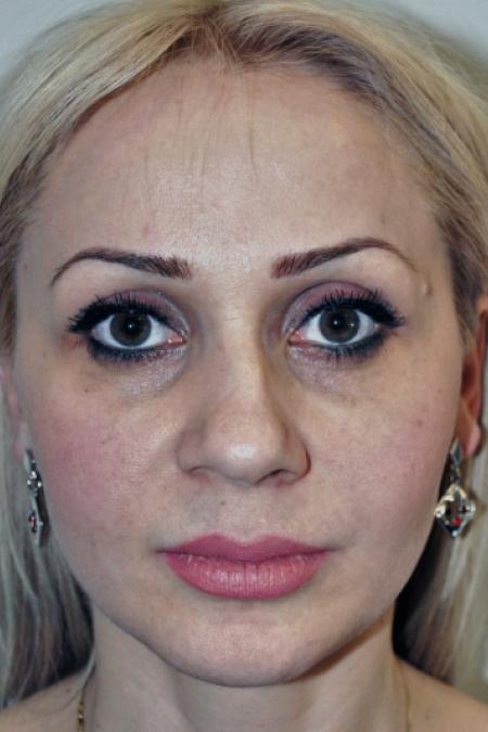 Before image 1 Case #122751 - Aesthetic Reduction Rhinoseptoplasty