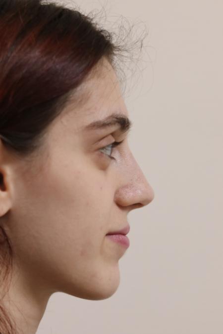 After image 4 Case #122786 - Aesthetic Reduction Rhinoseptoplasty