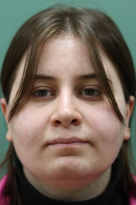 After image 1 Case #122866 - Nasal Deviation Syndrome