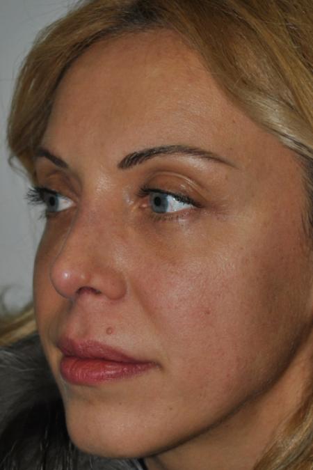 After image 2 Case #122731 - Revision Rhinoplasty
