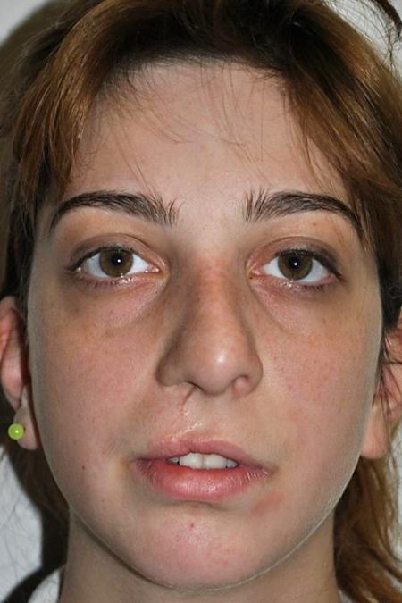 Before image 1 Case #122581 - Cleft-Lip Nose Secondary Reconstruction