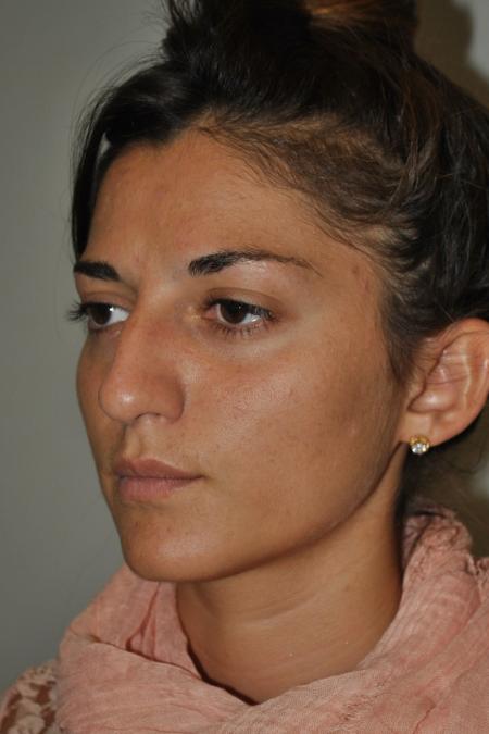 Before image 3 Case #122741 - Primary Rhinoseptoplasty, Turbinate Lateralization
