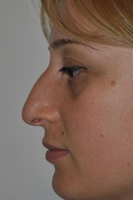 Before image 5 Case #122796 - Aesthetic Reduction Conventional Rhinoseptoplasty