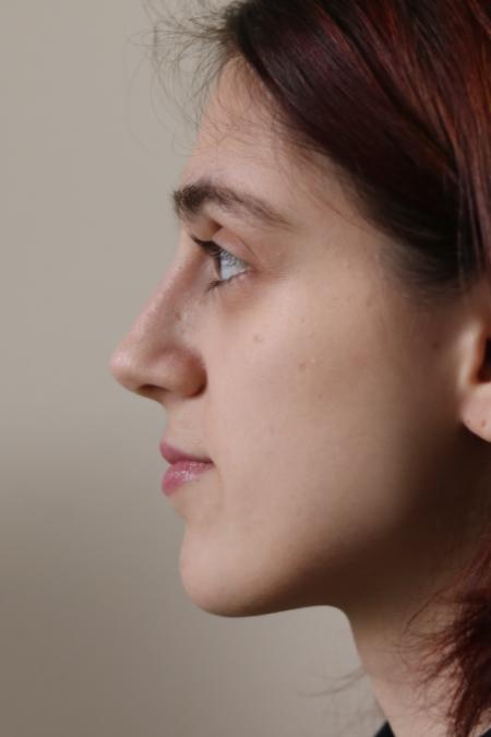 After image 5 Case #122786 - Aesthetic Reduction Rhinoseptoplasty