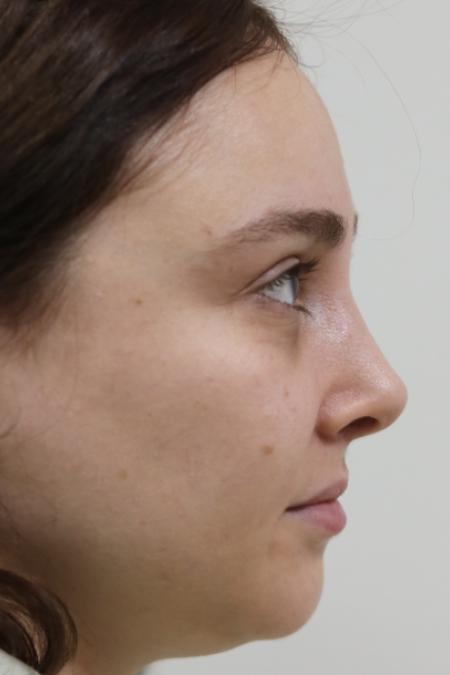 After image 4 Case #122861 - Aesthetic Reduction Rhinoplasty