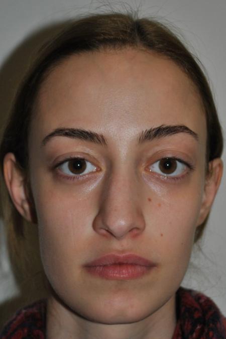 Before image 1 Case #122641 - Aesthetic Reduction Rhinoseptoplasty