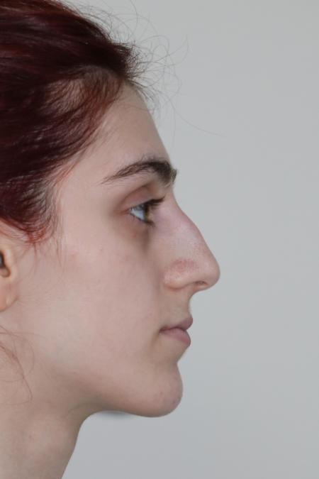 Before image 4 Case #122786 - Aesthetic Reduction Rhinoseptoplasty