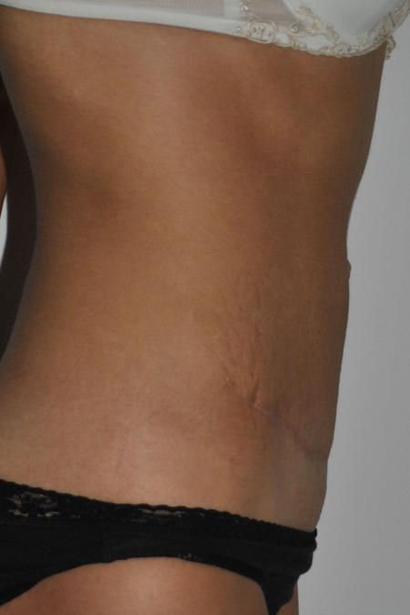 After image 3 Case #122716 - Abdominoplasty