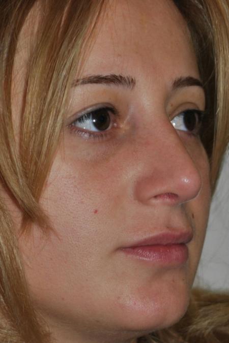 After image 3 Case #122796 - Aesthetic Reduction Conventional Rhinoseptoplasty