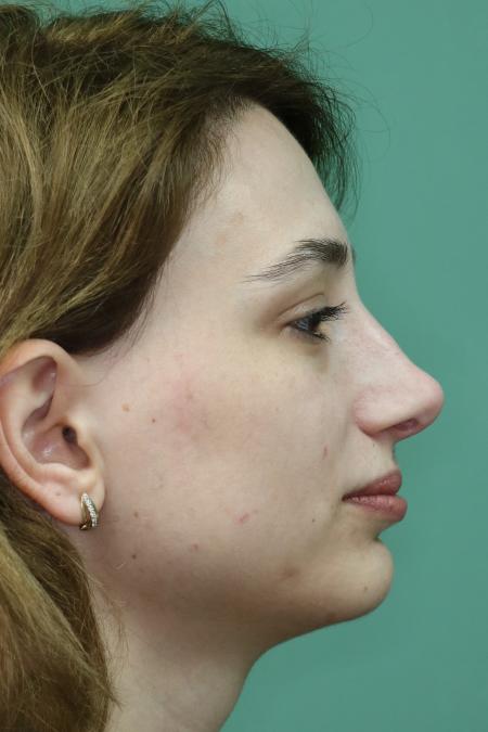 After image 4 Case #122881 - Deviation Syndrome. Rhinogenic Headache 