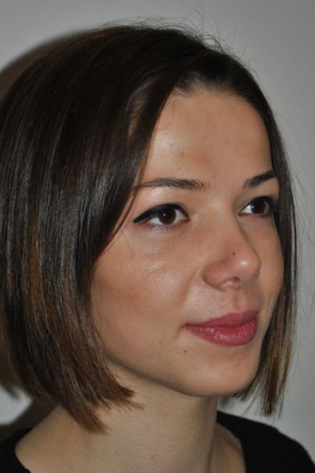 After image 3 Case #122616 - Aesthetic Reduction Rhinoplasty