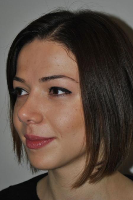After image 2 Case #122616 - Aesthetic Reduction Rhinoplasty