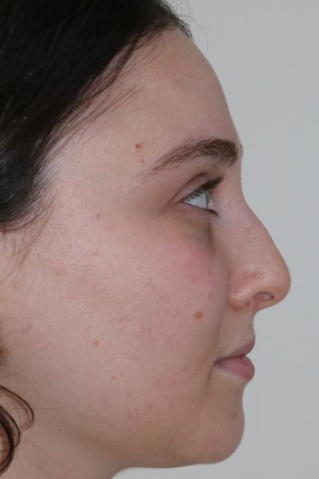 Before image 4 Case #122861 - Aesthetic Reduction Rhinoplasty
