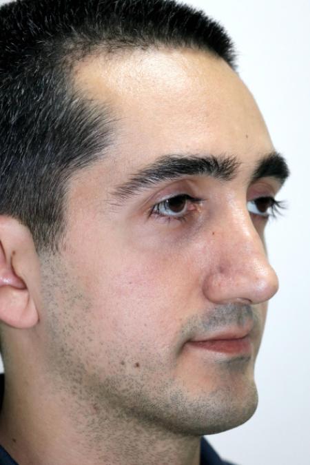 Before image 2 Case #122726 - Revision Rhinoseptoplasty, Turbinoplasty