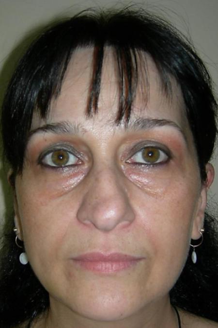 Before image 1 Case #122596 - Aging Rhinoseptoplasty