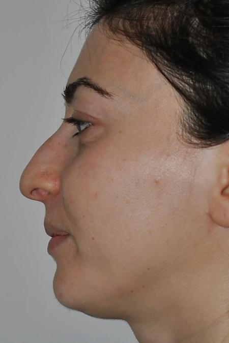 Before image 5 Case #122636 - Aestetic Reduction Rhinoseptoplasty