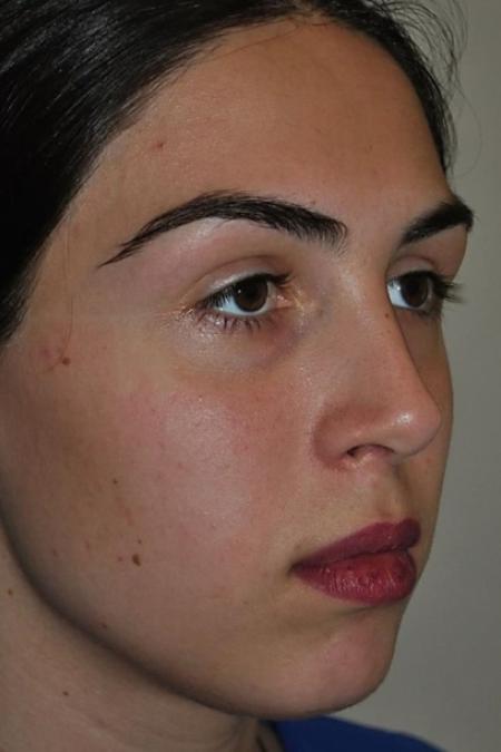 After image 2 Case #122621 - Aesthetic Reduction Rhinoseptoplasty