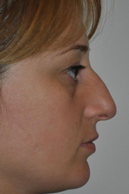 Before image 4 Case #122796 - Aesthetic Reduction Conventional Rhinoseptoplasty