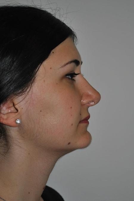 After image 4 Case #122746 - Rhinoseptoplasty