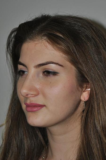 After image 3 Case #122771 - Aesthetic Reduction Rhinoplasty