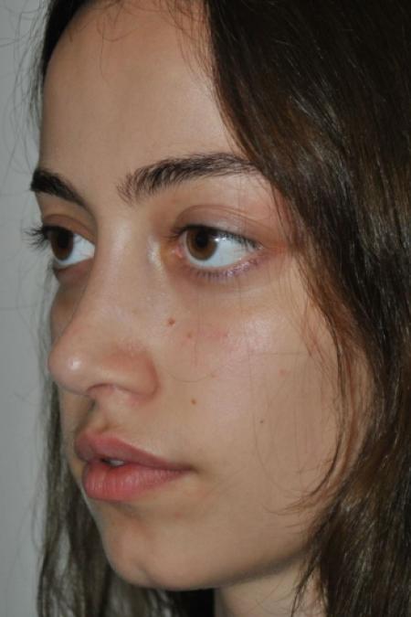 After image 3 Case #122641 - Aesthetic Reduction Rhinoseptoplasty