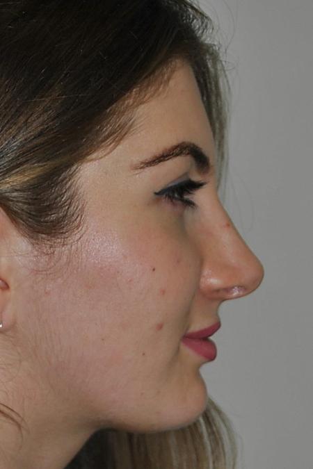 After image 4 Case #122771 - Aesthetic Reduction Rhinoplasty