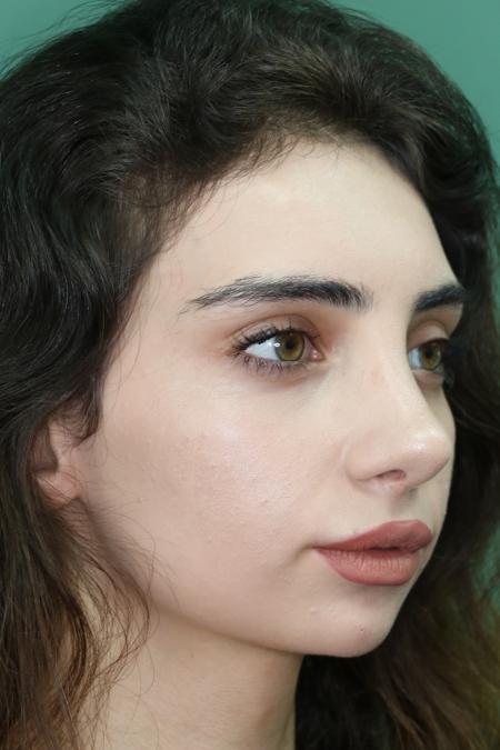 After image 2 Case #122491 - Aesthetic Reduction Rhinoseptoplasty